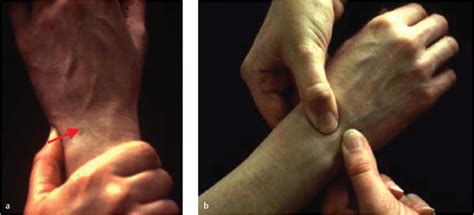 lunotriquetral compression test|lunotriquetral ligament injury hand test.